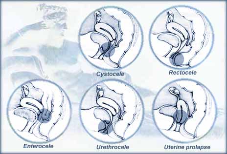 Cistocele | Rectocele | Enterocele | Uretrocele | Prolapsus utérin